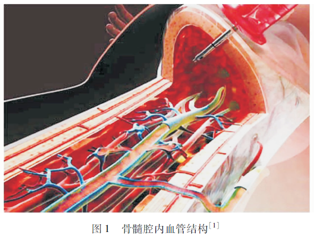 中国骨髓腔内输液通路临床应用专家共识